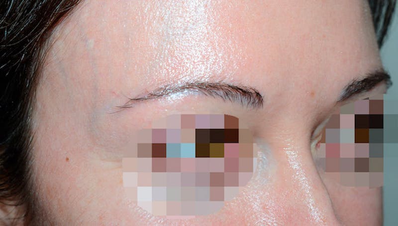Eyebrow Transplantation Before & After Gallery - Patient 429093 - Image 5