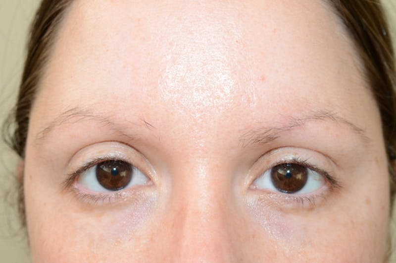 Eyebrow Transplantation Before & After Gallery - Patient 305873 - Image 3