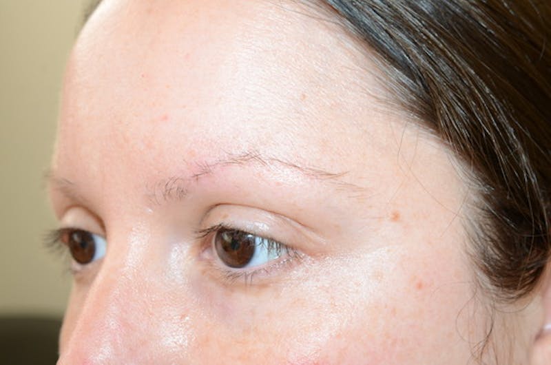 Eyebrow Transplantation Before & After Gallery - Patient 305873 - Image 5