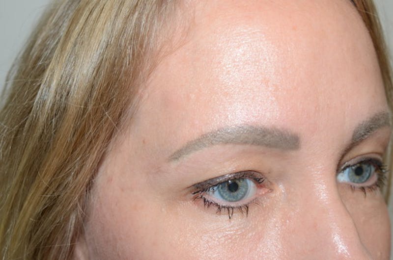 Eyebrow Transplantation Before & After Gallery - Patient 231659 - Image 5