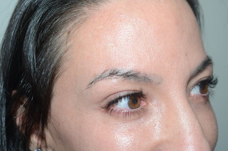 Eyebrow Transplantation Before & After Gallery - Patient 251957 - Image 3