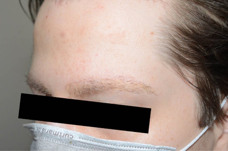 Eyebrow Transplantation Before & After Gallery - Patient 133300 - Image 3