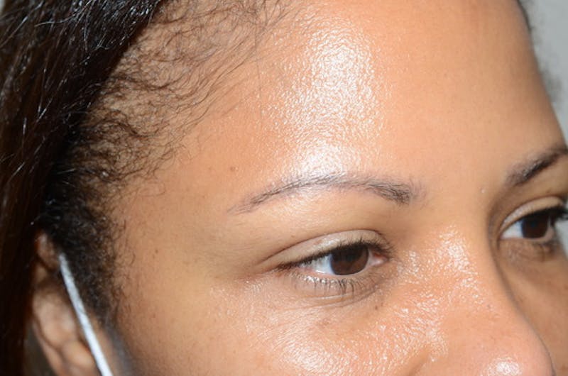 Eyebrow Transplantation Before & After Gallery - Patient 336107 - Image 5