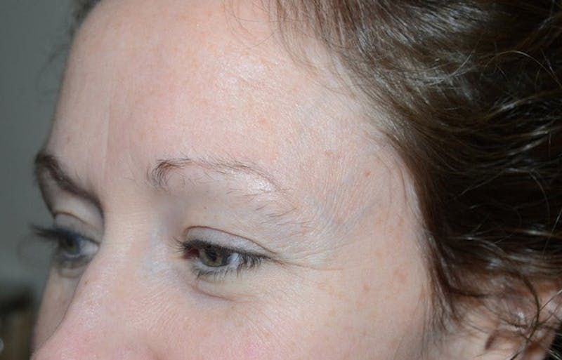 Eyebrow Transplantation Before & After Gallery - Patient 302638 - Image 3