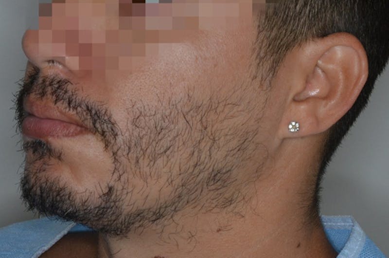 Facial Hair Transplant Before & After Gallery - Patient 617532 - Image 3