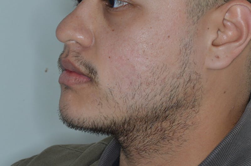 Facial Hair Transplant Before & After Gallery - Patient 241085 - Image 3