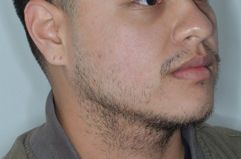 Facial Hair Transplant Before & After Gallery - Patient 241085 - Image 5