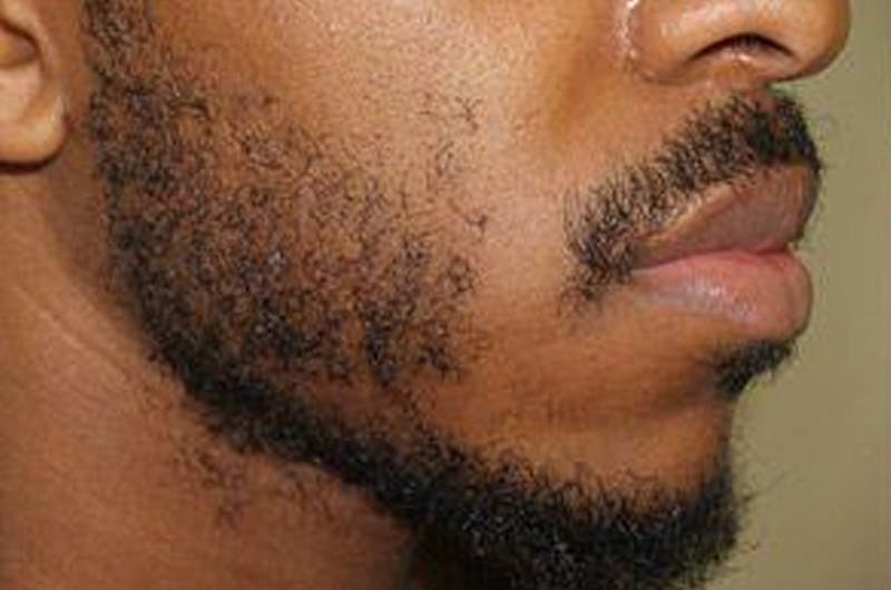 Facial Hair Transplant Before & After Gallery - Patient 225342 - Image 3