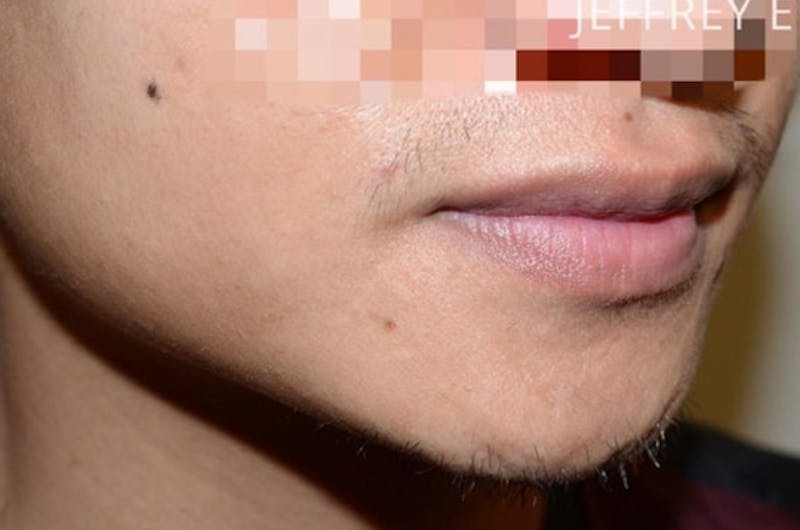 Facial Hair Transplant Before & After Gallery - Patient 294368 - Image 3