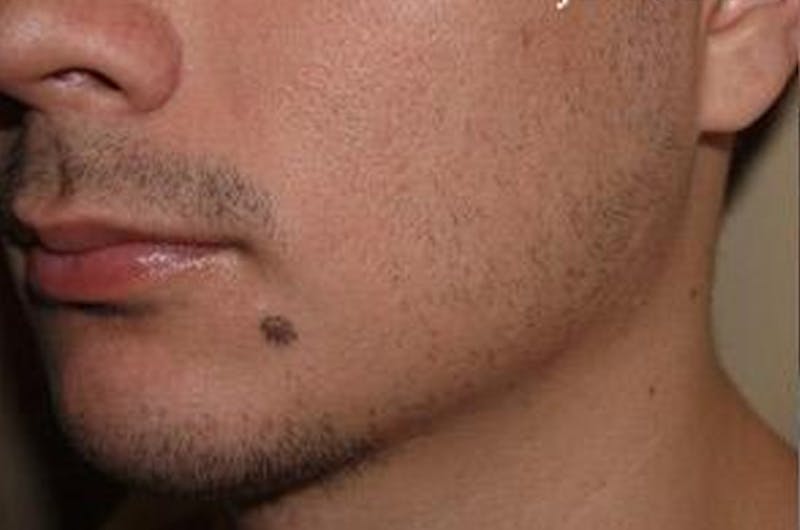 Facial Hair Transplant Before & After Gallery - Patient 148511 - Image 3