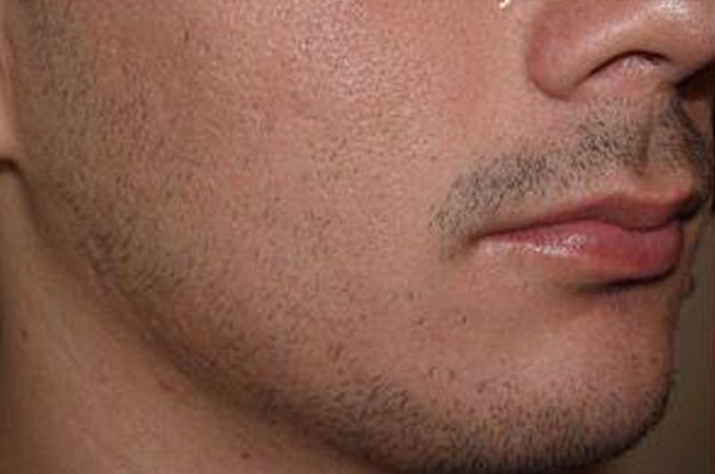 Facial Hair Transplant Before & After Gallery - Patient 148511 - Image 5
