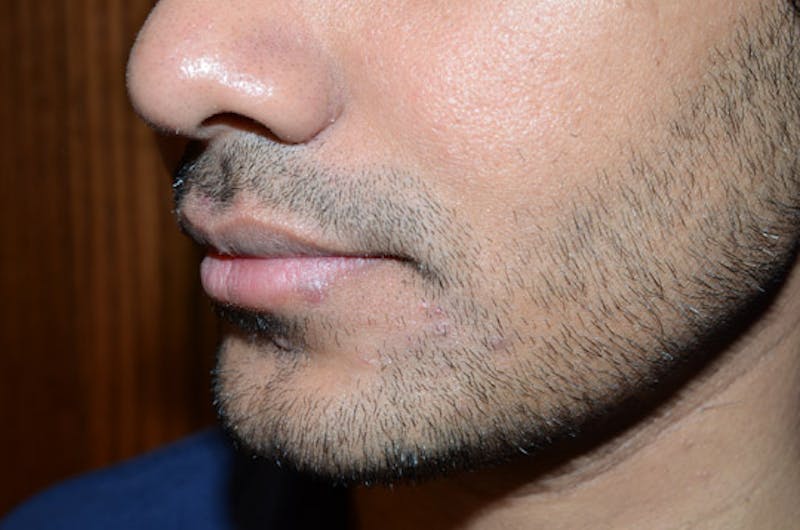 Facial Hair Transplant Before & After Gallery - Patient 260698 - Image 3