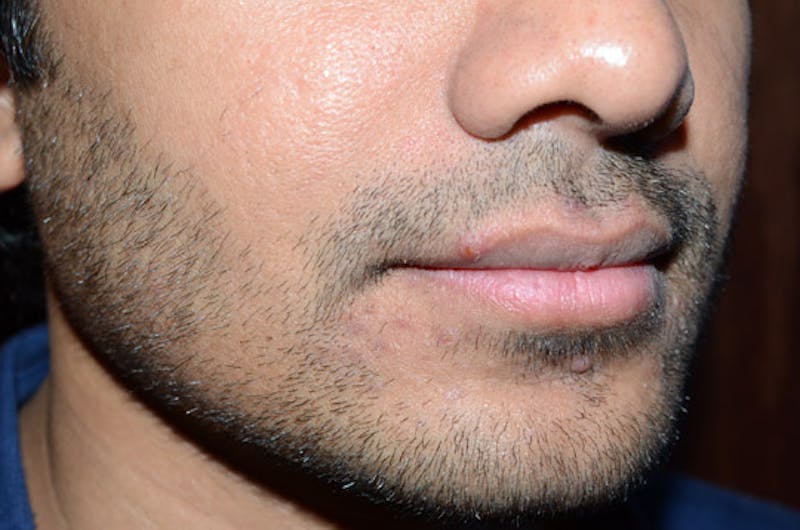 Facial Hair Transplant Before & After Gallery - Patient 260698 - Image 5