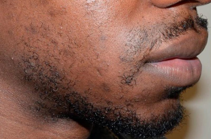Facial Hair Transplant Before & After Gallery - Patient 680870 - Image 3