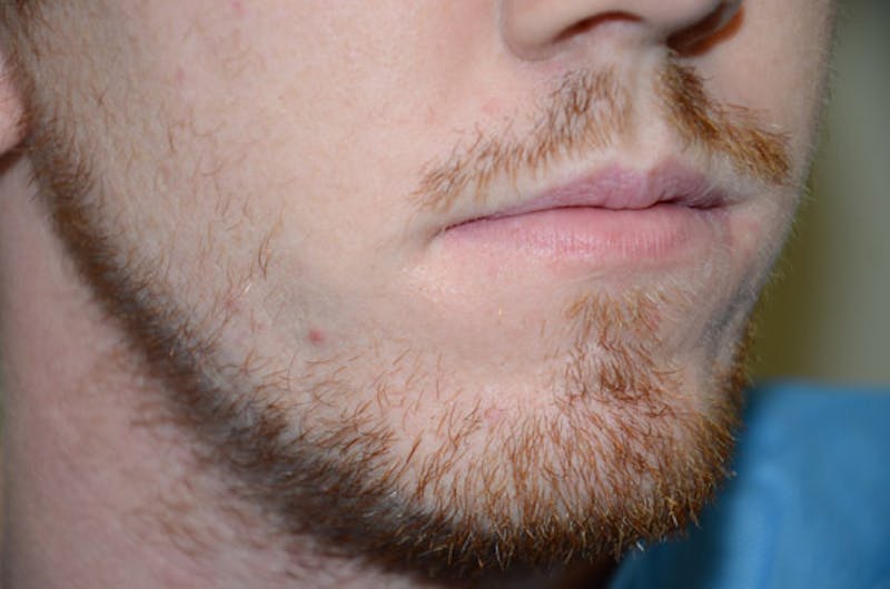 Facial Hair Transplant Before & After Gallery - Patient 428627 - Image 3