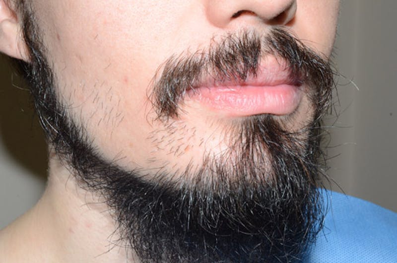 Facial Hair Transplant Before & After Gallery - Patient 977017 - Image 3