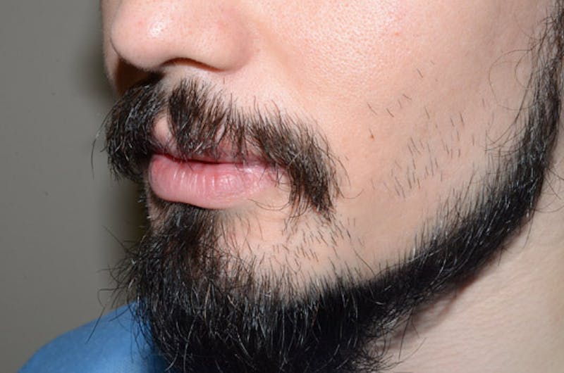 Facial Hair Transplant Before & After Gallery - Patient 977017 - Image 5