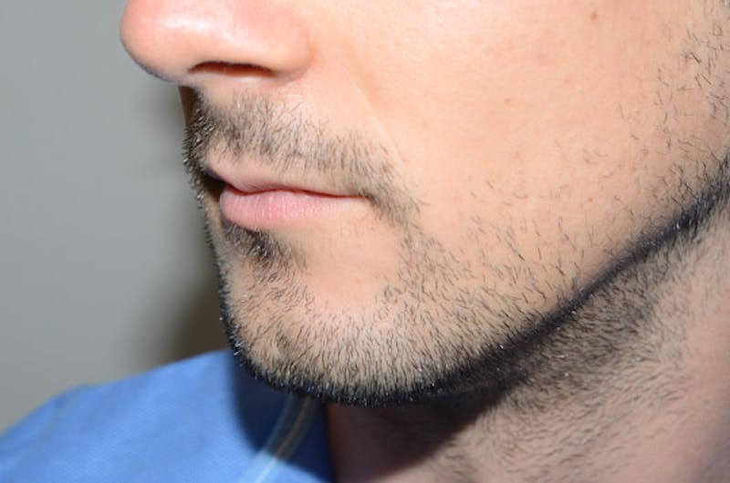 Facial Hair Transplant Before & After Gallery - Patient 116066 - Image 3