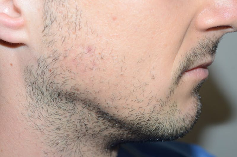 Facial Hair Transplant Before & After Gallery - Patient 116066 - Image 5