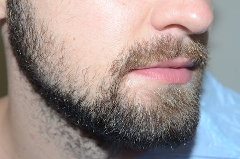 Facial Hair Transplant Before & After Gallery - Patient 153287 - Image 3