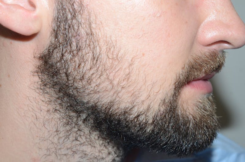 Facial Hair Transplant Before & After Gallery - Patient 153287 - Image 5