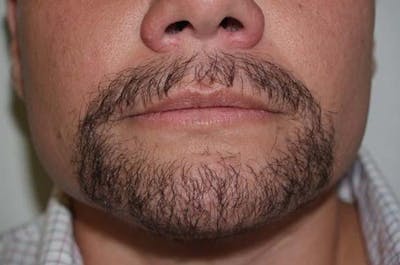Facial Hair Transplant Before & After Gallery - Patient 146522 - Image 2