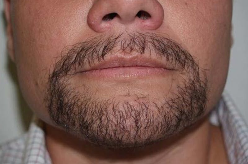 Hair for Gender Reaffirmation Before & After Gallery - Patient 599718 - Image 2