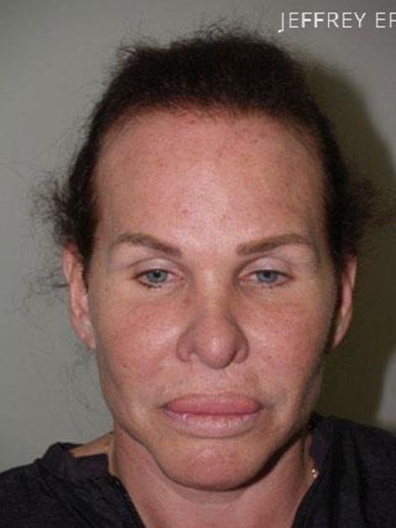 Hair for Gender Reaffirmation Before & After Gallery - Patient 902722 - Image 1