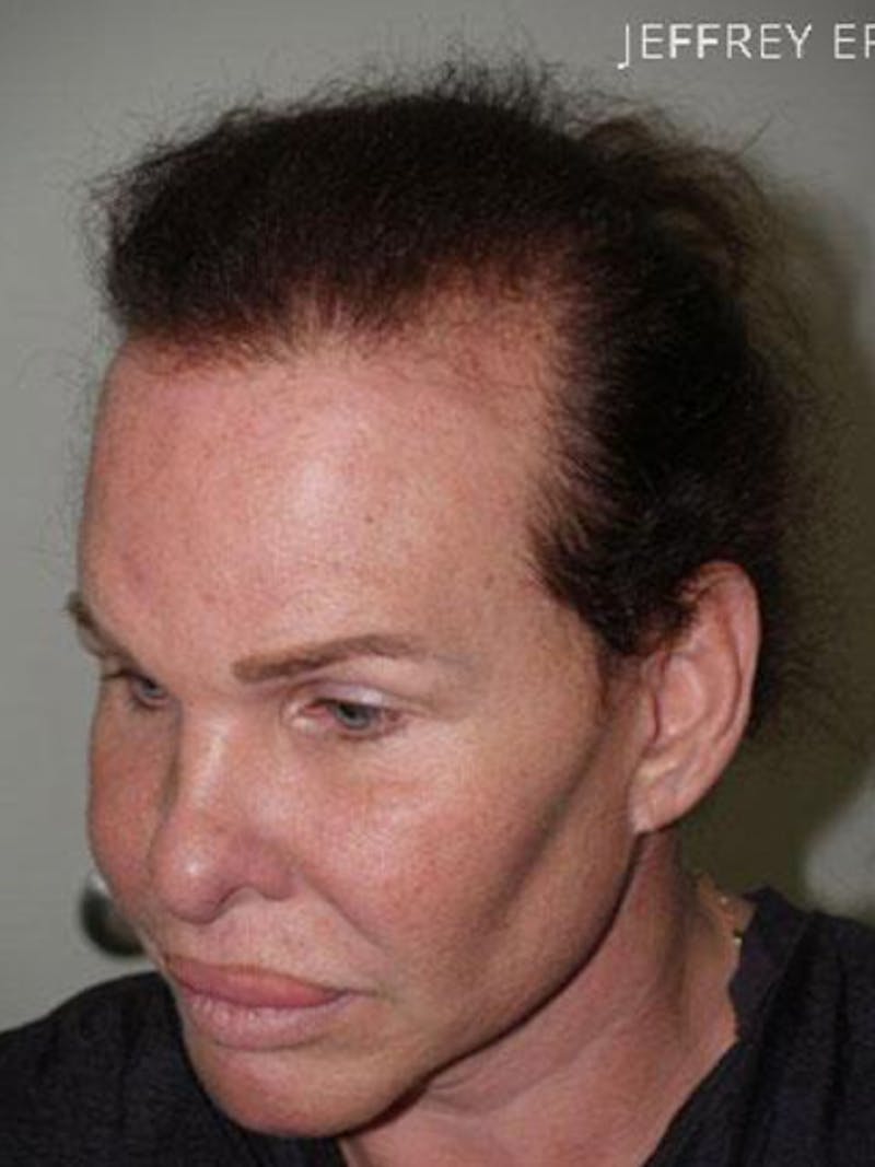 Hair for Gender Reaffirmation Before & After Gallery - Patient 902722 - Image 3
