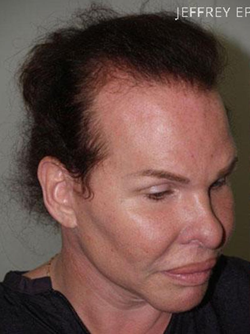 Hair for Gender Reaffirmation Before & After Gallery - Patient 902722 - Image 5