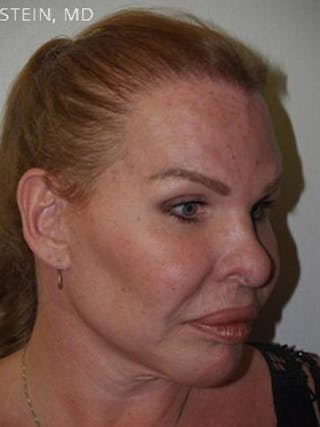 Hairline Lowering Surgery Before & After Gallery - Patient 417733 - Image 6