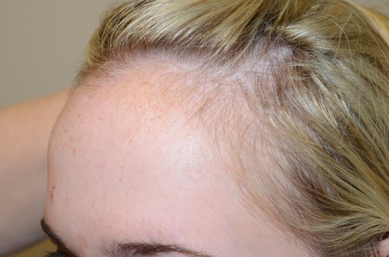 Hairline Lowering Surgery Before & After Gallery - Patient 275317 - Image 3