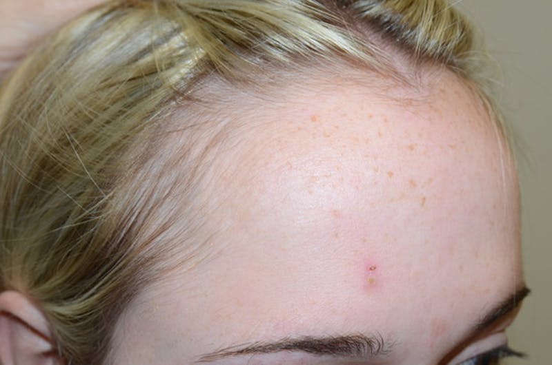 Hairline Lowering Surgery Before & After Gallery - Patient 275317 - Image 5