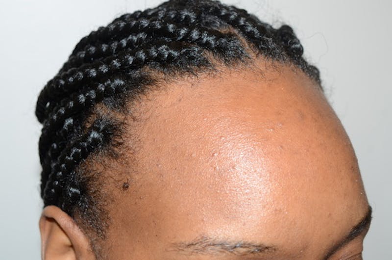 Hairline Lowering Surgery Before & After Gallery - Patient 435634 - Image 5