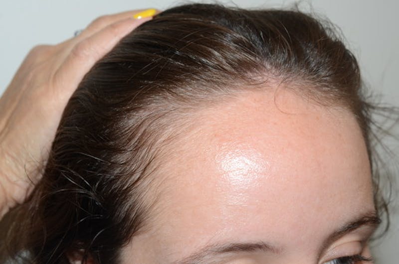 Hairline Lowering Surgery Before & After Gallery - Patient 226704 - Image 5