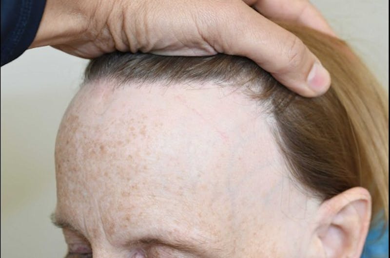 Hairline Lowering Surgery Before & After Gallery - Patient 414736 - Image 3