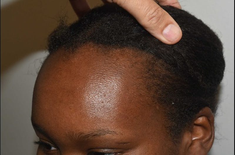Hairline Lowering Surgery Before & After Gallery - Patient 209152 - Image 3