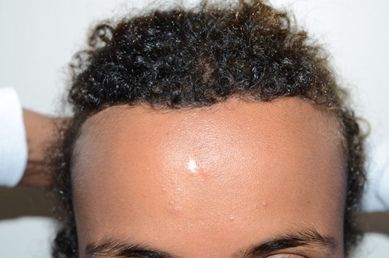Hairline Lowering Surgery Before & After Gallery - Patient 312739 - Image 2