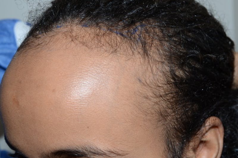 Hairline Lowering Surgery Before & After Gallery - Patient 312739 - Image 3