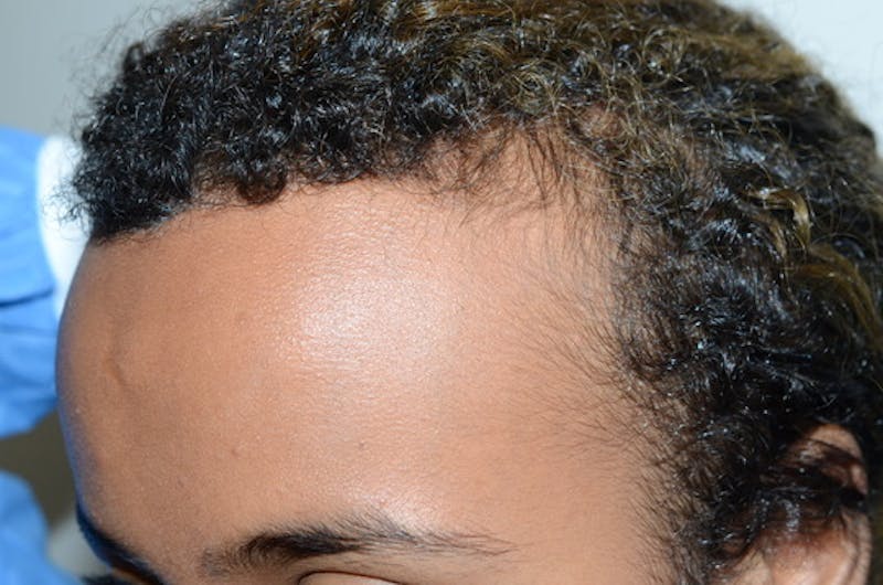 Hairline Lowering Surgery Before & After Gallery - Patient 312739 - Image 4