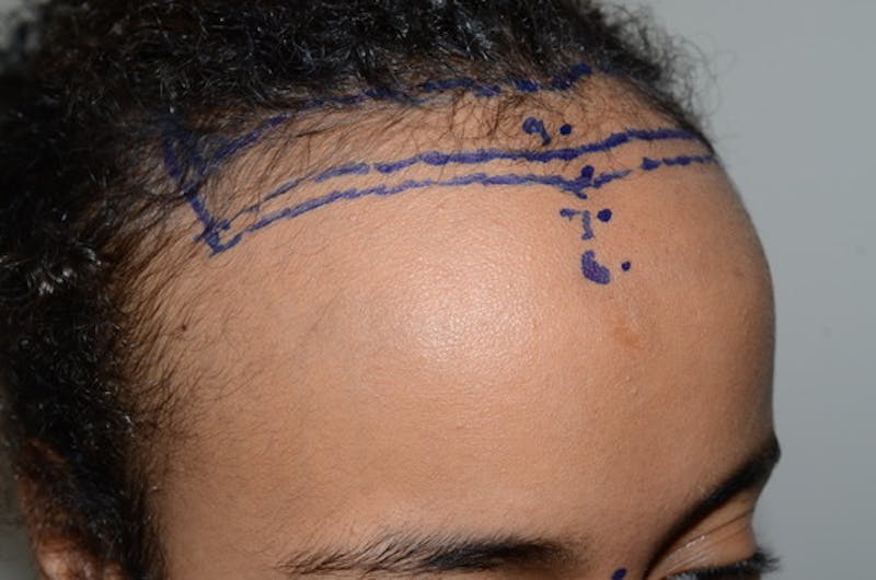 Hairline Lowering Surgery Before & After Gallery - Patient 312739 - Image 5