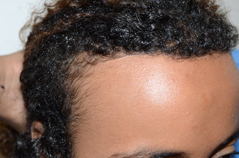Hairline Lowering Surgery Before & After Gallery - Patient 312739 - Image 6