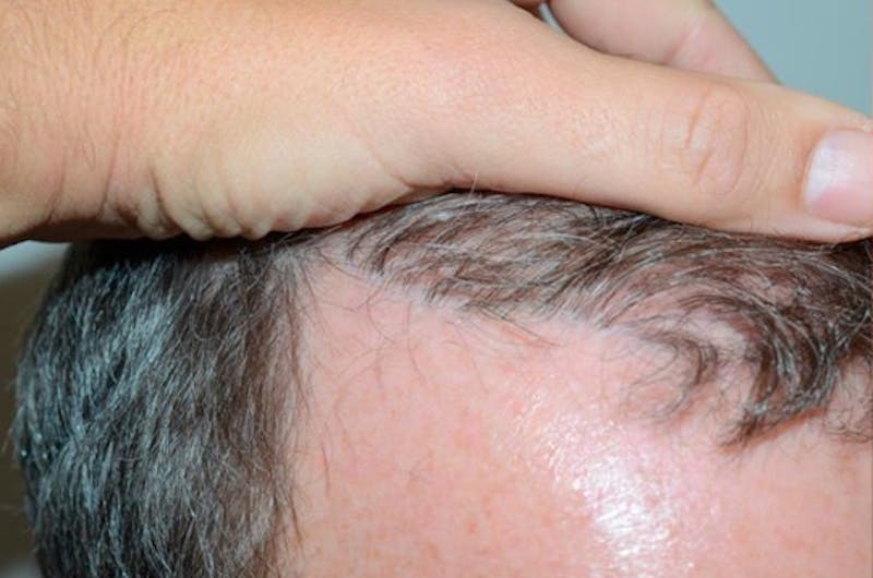 Body Hair Transplants Before & After Gallery - Patient 362612 - Image 3