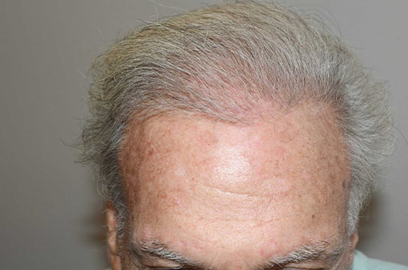 Body Hair Transplants Before & After Gallery - Patient 242865 - Image 2
