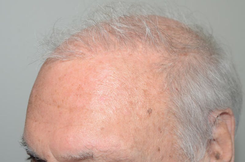 Body Hair Transplants Before & After Gallery - Patient 242865 - Image 3