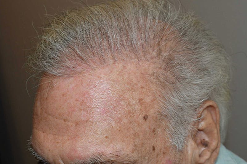 Body Hair Transplants Before & After Gallery - Patient 242865 - Image 4
