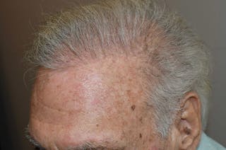 Body Hair Transplants Before & After Gallery - Patient 109577 - Image 6