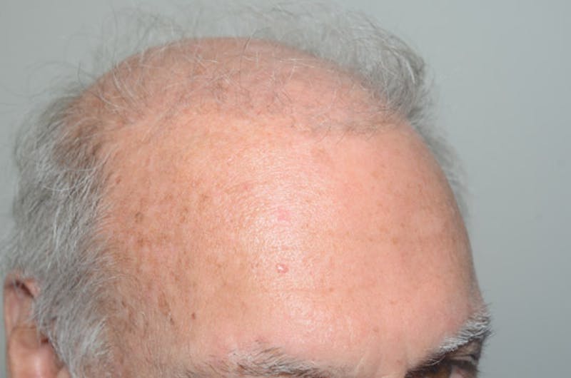 Body Hair Transplants Before & After Gallery - Patient 242865 - Image 5