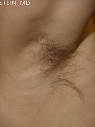 Body Hair Transplants Before & After Gallery - Patient 236325 - Image 2