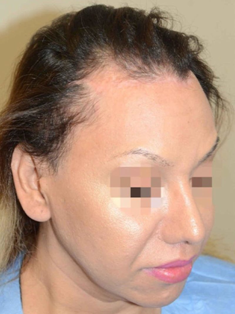 Special Cases Before & After Gallery - Patient 151257 - Image 5